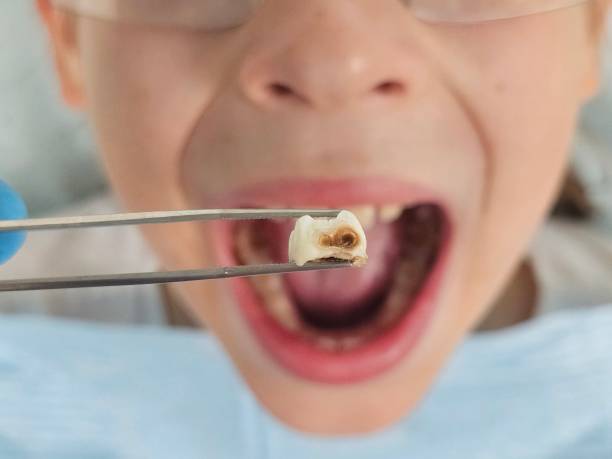 Best Emergency Wisdom Teeth Removal in Athens, PA